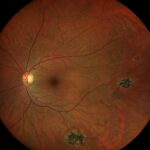 Clinical eye photograph illustrating Sildenafil and the Retina Cyanopsia