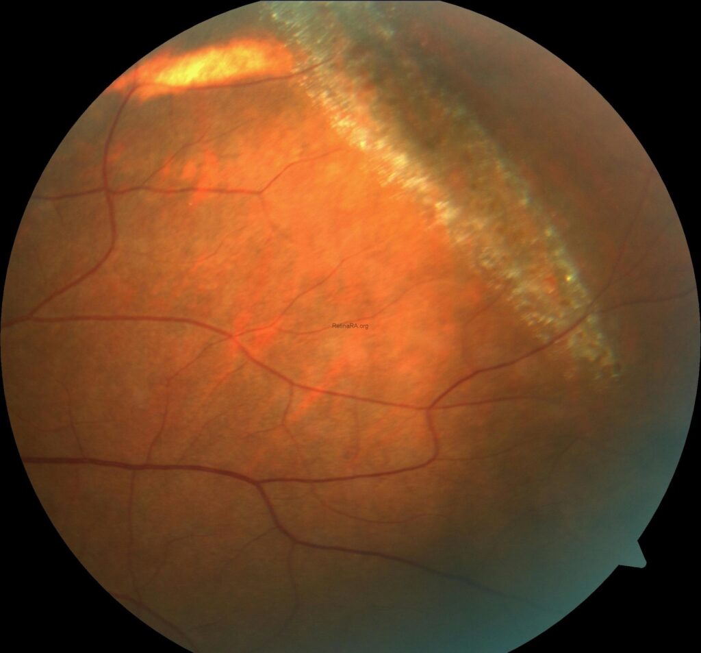 Clinical eye photograph illustrating Snail Track Degeneration