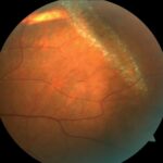 Clinical eye photograph illustrating Snail Track Degeneration