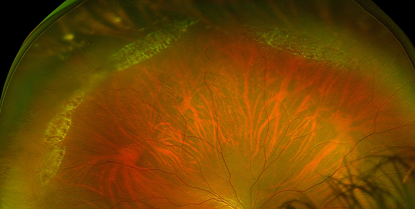 Clinical eye photograph illustrating Snail Track Degeneration