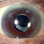 Clinical eye photograph illustrating Soemmering Ring After Cataract Surgery