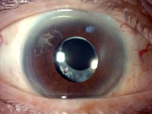 Soemmering Ring: The Doughnut of Retained Lens Material Left Behind After Cataract Surgery