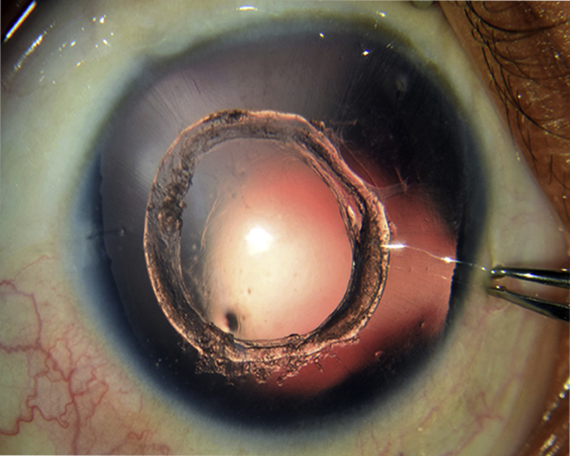 Clinical eye photograph illustrating Soemmering Ring After Cataract Surgery