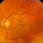 Clinical eye photograph illustrating Soft Drusen vs Hard Drusen Amd Risk