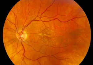 Clinical eye photograph illustrating Soft Drusen vs Hard Drusen Amd Risk