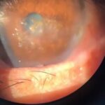 Clinical eye photograph illustrating Spheroidal Degeneration Climatic Droplet Keratopathy
