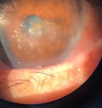 Spheroidal Degeneration: Corneal Weathering From a Lifetime in the Sun
