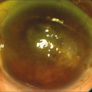 Clinical eye photograph illustrating Spheroidal Degeneration Climatic Droplet Keratopathy