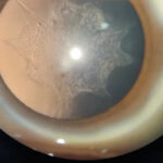 Clinical eye photograph illustrating Steroid Induced Cataract