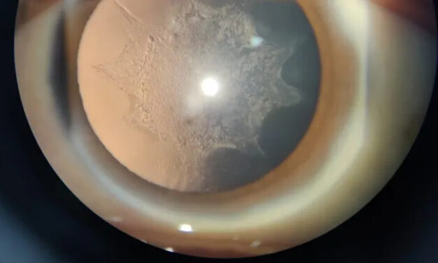 Steroid-Induced Cataract: How Corticosteroids Cloud the Back of the Lens