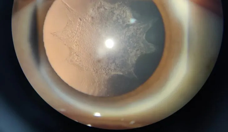 Steroid-Induced Cataract: How Corticosteroids Cloud the Back of the Lens