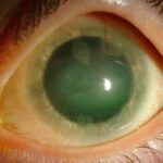 Clinical eye photograph illustrating Stevens Johnson Syndrome Ocular Sequelae