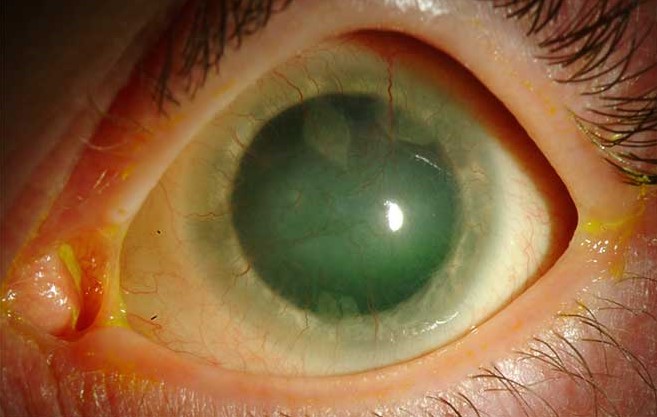 Clinical eye photograph illustrating Stevens Johnson Syndrome Ocular Sequelae