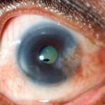 Clinical image illustrating Stocker’s Line