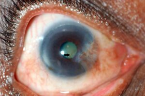 Clinical image illustrating Stocker’s Line