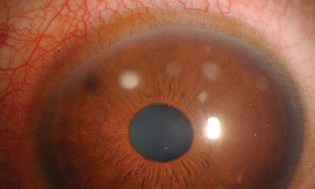 Clinical image illustrating Subepithelial Infiltrates (Viral Spots) (figure 1)