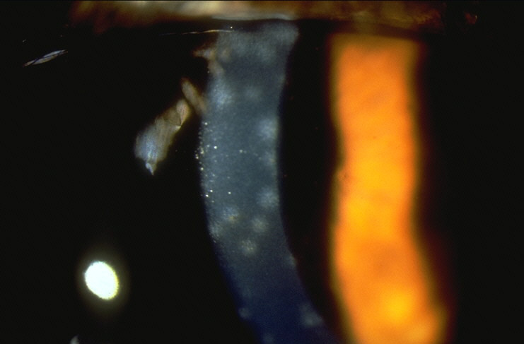 Clinical image illustrating Subepithelial Infiltrates (Viral Spots) (figure 2)