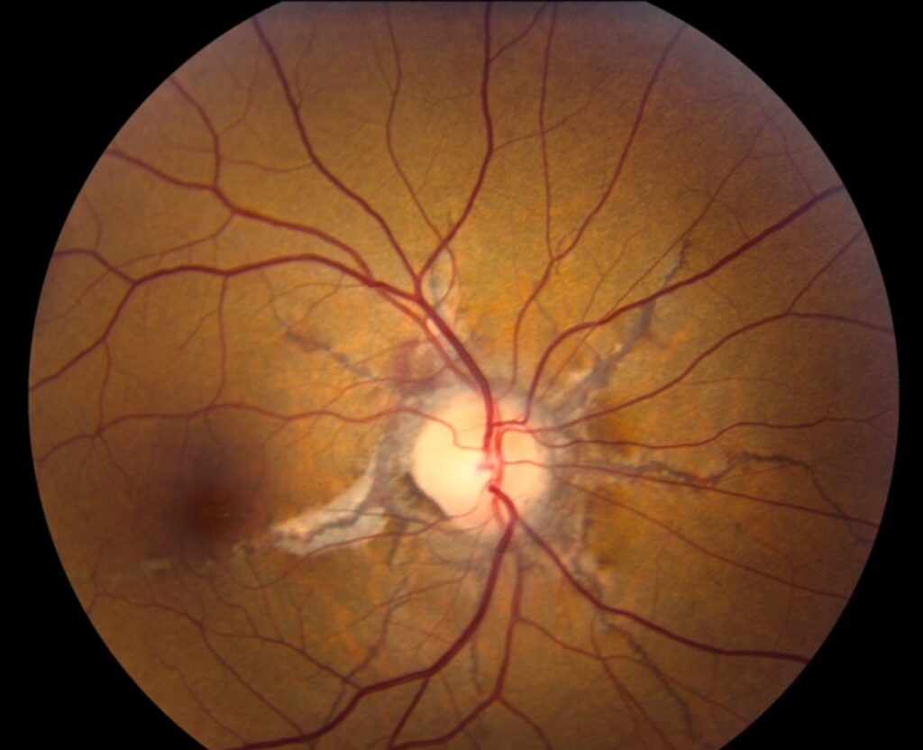 Clinical eye photograph illustrating Submacular Surgery Trials