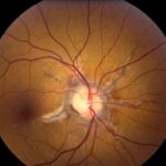 Clinical eye photograph illustrating Submacular Surgery Trials