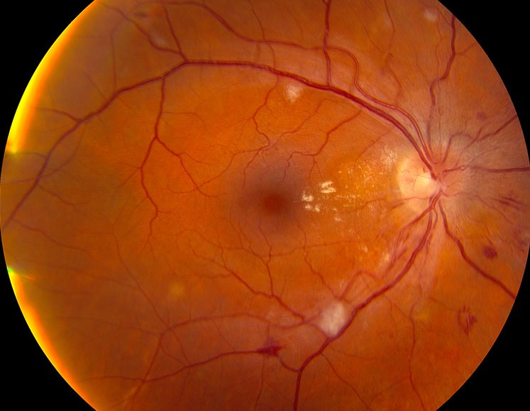 Clinical eye photograph illustrating Submacular Surgery Trials