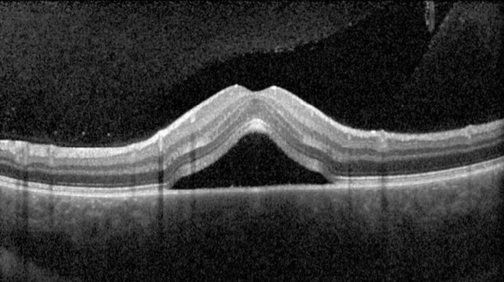 Clinical eye photograph illustrating Subretinal Fluid Oct