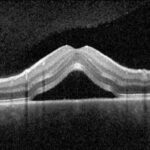 Clinical eye photograph illustrating Subretinal Fluid Oct