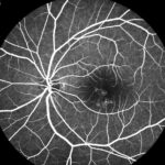 Clinical image illustrating Subthreshold Micropulse Laser