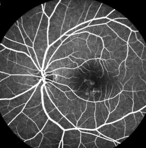 Clinical image illustrating Subthreshold Micropulse Laser
