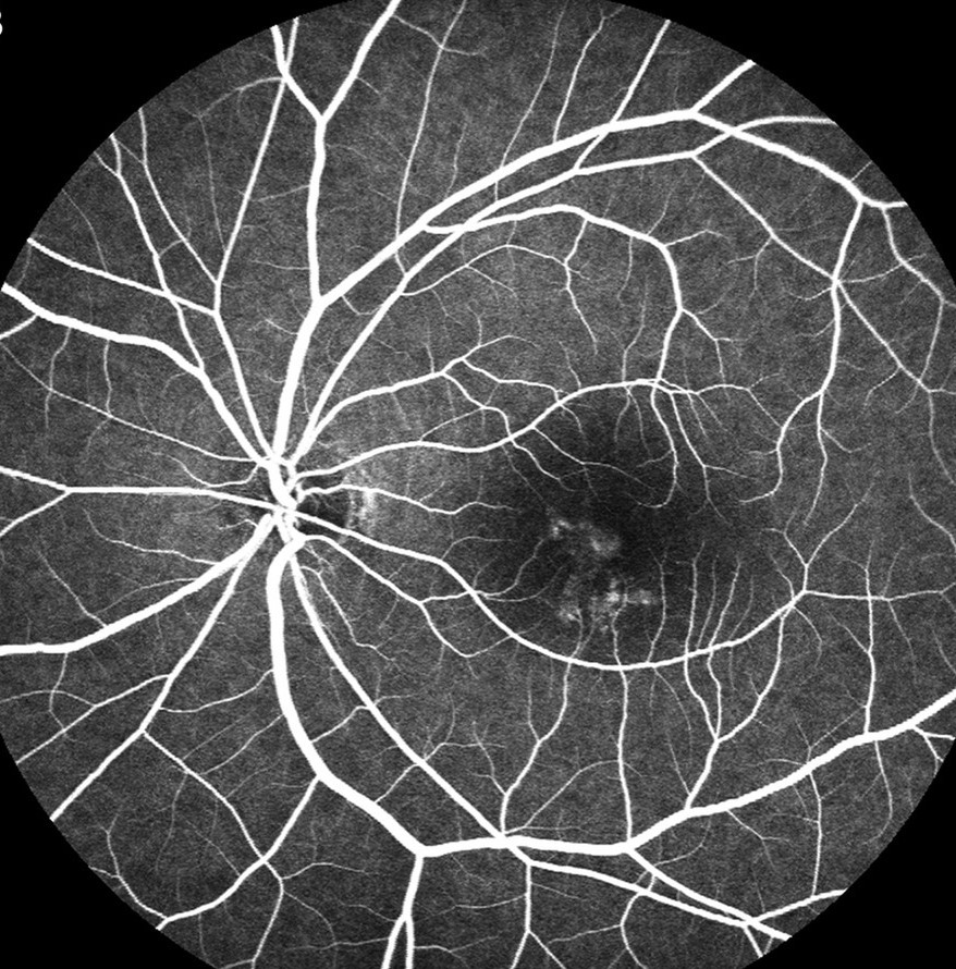 Clinical image illustrating Subthreshold Micropulse Laser