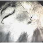 Clinical image illustrating Sudden Floaters