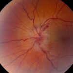 Clinical image illustrating Sudden Vision Loss