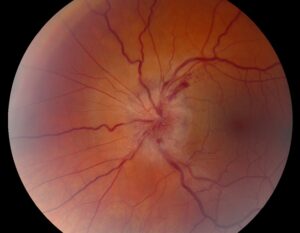 Clinical image illustrating Sudden Vision Loss