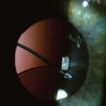 Clinical eye photograph illustrating Sulcus Fixated Iol