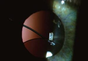 Clinical eye photograph illustrating Sulcus Fixated Iol