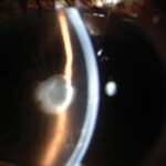 Clinical eye photograph illustrating Sun Classification Uveitis Anatomic Grading