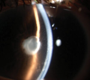 Clinical eye photograph illustrating Sun Classification Uveitis Anatomic Grading