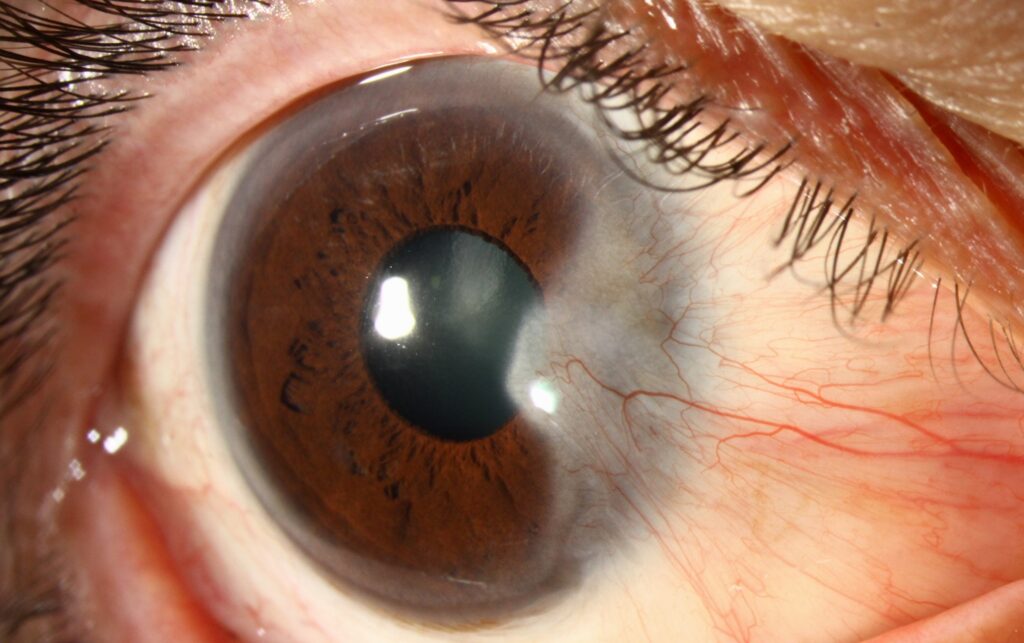 Clinical image illustrating Sunglasses and Eye Protection