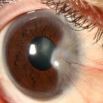 Clinical image illustrating Sunglasses and Eye Protection