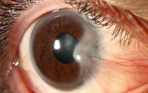 Clinical image illustrating Sunglasses and Eye Protection