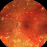 Clinical eye photograph illustrating Sunset Glow Fundus Vkh