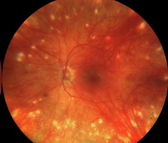 Sunset Glow Fundus: Why the Fundus Turns Orange-Red After Vogt-Koyanagi-Harada Disease