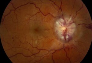 Clinical image illustrating Superglue in Eye (Glued Eyelids)