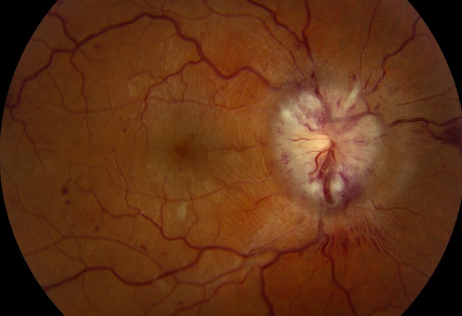 Clinical image illustrating Superglue in Eye (Glued Eyelids)
