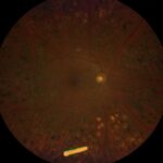 Clinical eye photograph illustrating Sustained Release Drug Delivery Retina