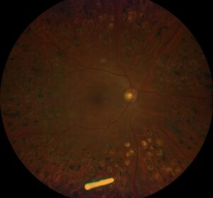 Clinical eye photograph illustrating Sustained Release Drug Delivery Retina
