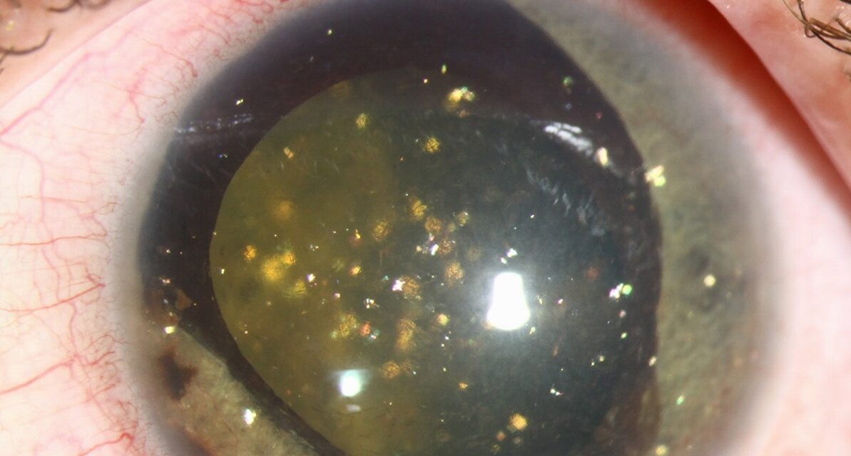 Synchysis Scintillans Versus Asteroid Hyalosis: Two Sparkling Vitreous Findings That Aren’t the Same
