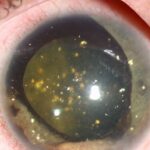 Clinical eye photograph illustrating Synchysis Scintillans vs Asteroid Hyalosis