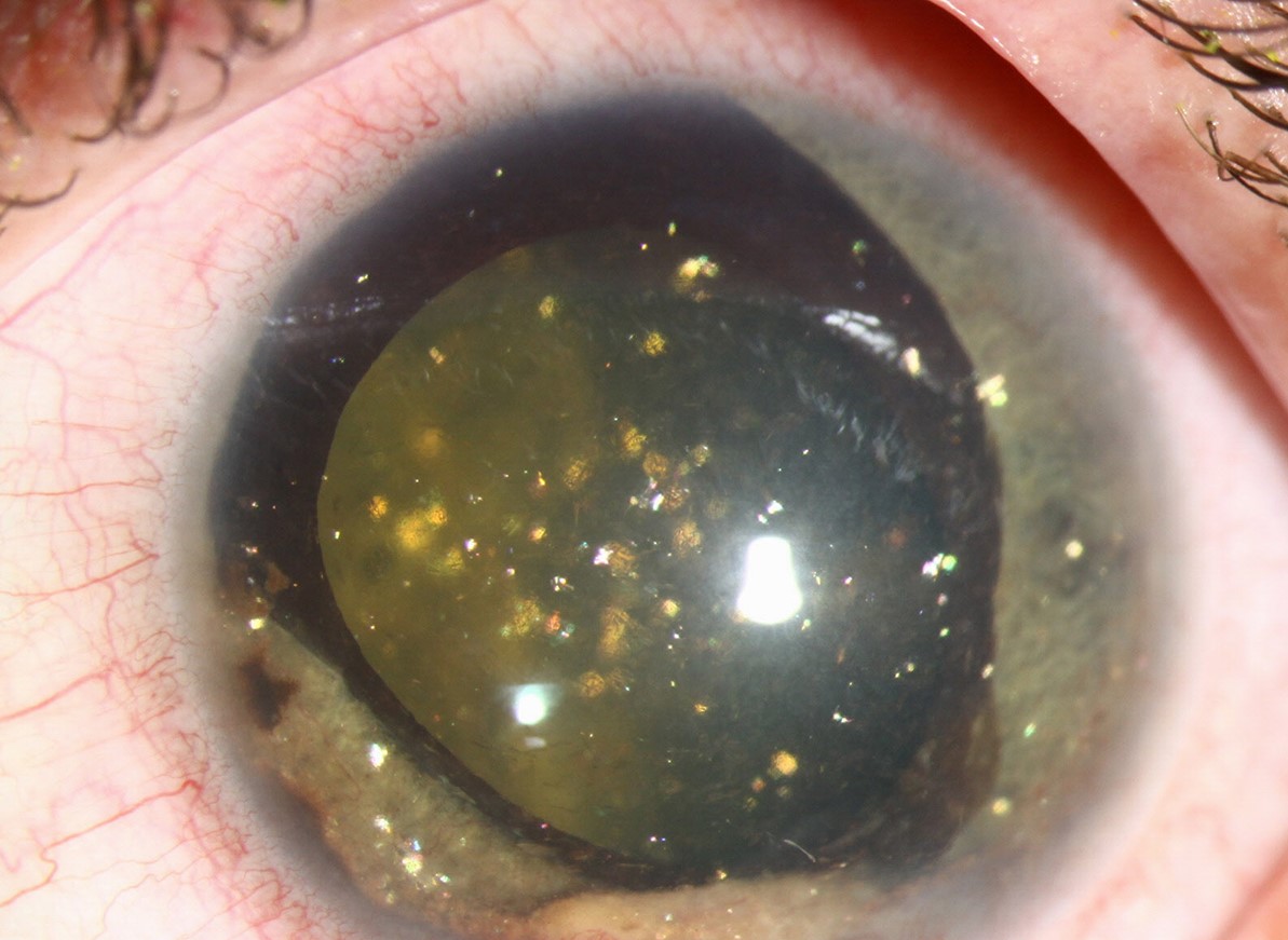 Clinical eye photograph illustrating Synchysis Scintillans vs Asteroid Hyalosis