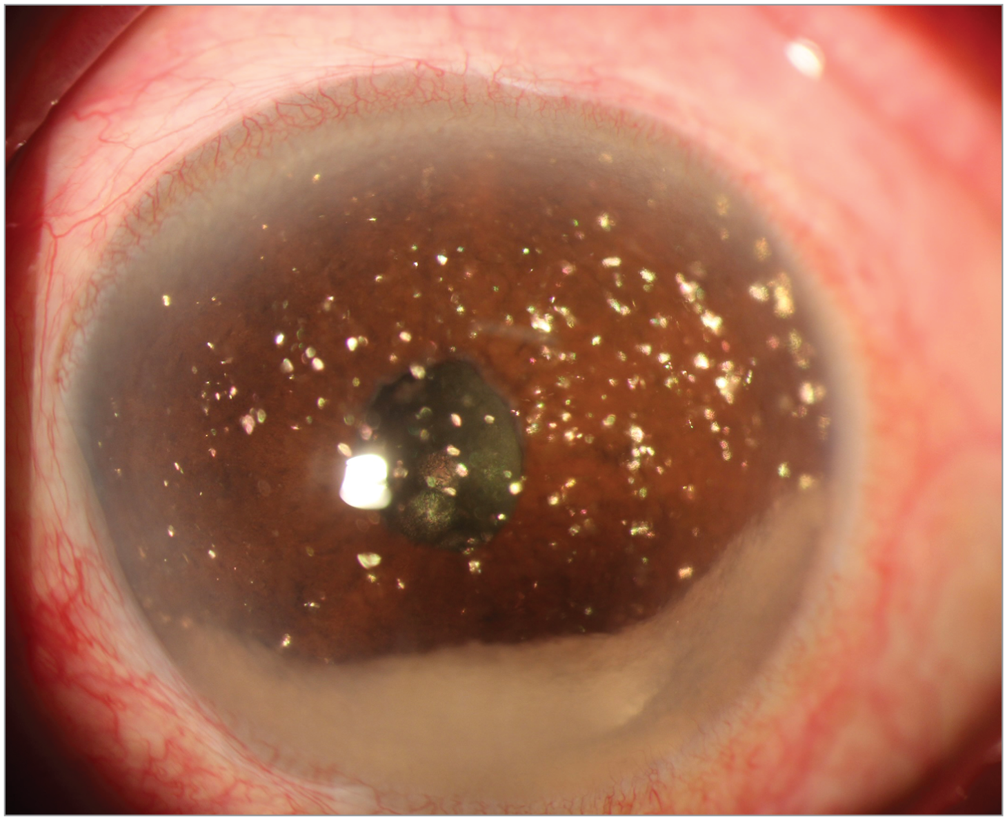Clinical eye photograph illustrating Synchysis Scintillans vs Asteroid Hyalosis
