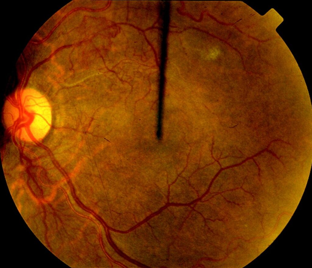 Systemic Sclerosis: Eye and Retinal Findings